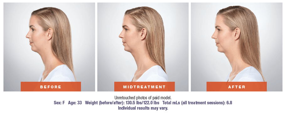 kybella patient before and after