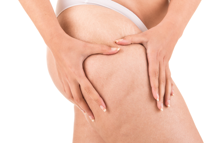 How Can You Get Rid of Cellulite? Discover QWO Blog Post Featured Image