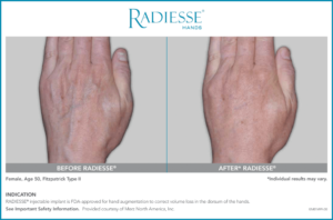 radiesse before and after