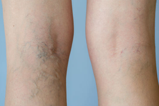 Sclerotherapy for Spider Vein Removal Blog Post Featured Image