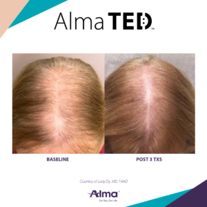 Patient before and after Alma TED treatment