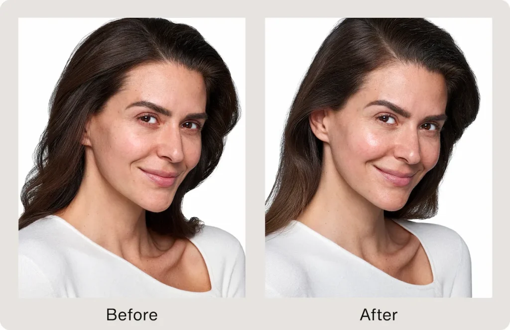 Before and after skinvive 