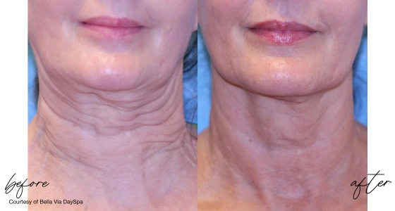 Before and after photos of Sofwave treatment