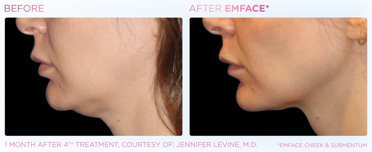 Patient results emface submentum before and after